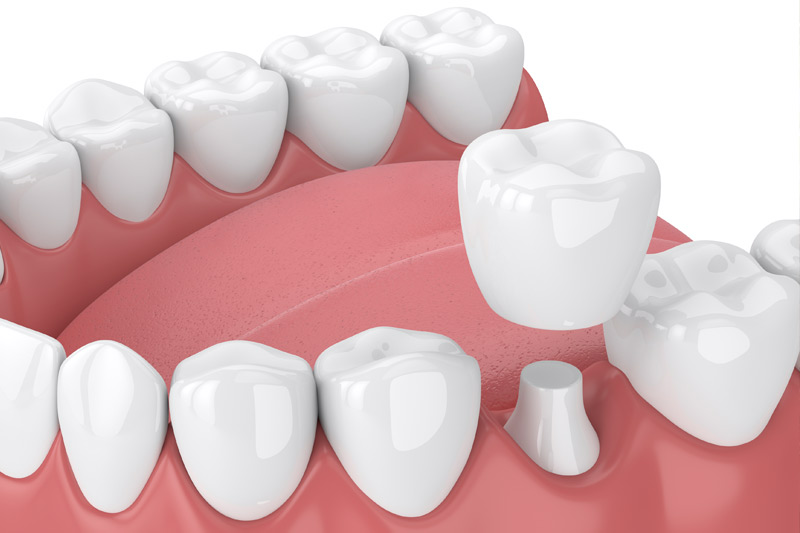 Dental Crowns in Haverhill