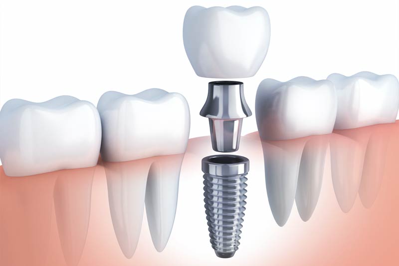 Implants Dentist in Haverhill