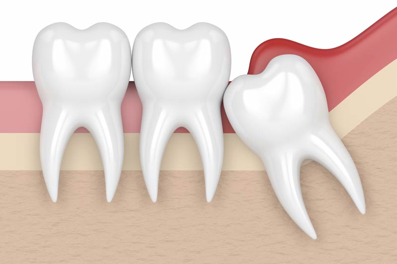 Wisdom Tooth Removal in Haverhill